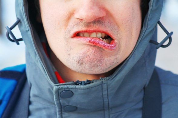 Chapped Lips - Prepping